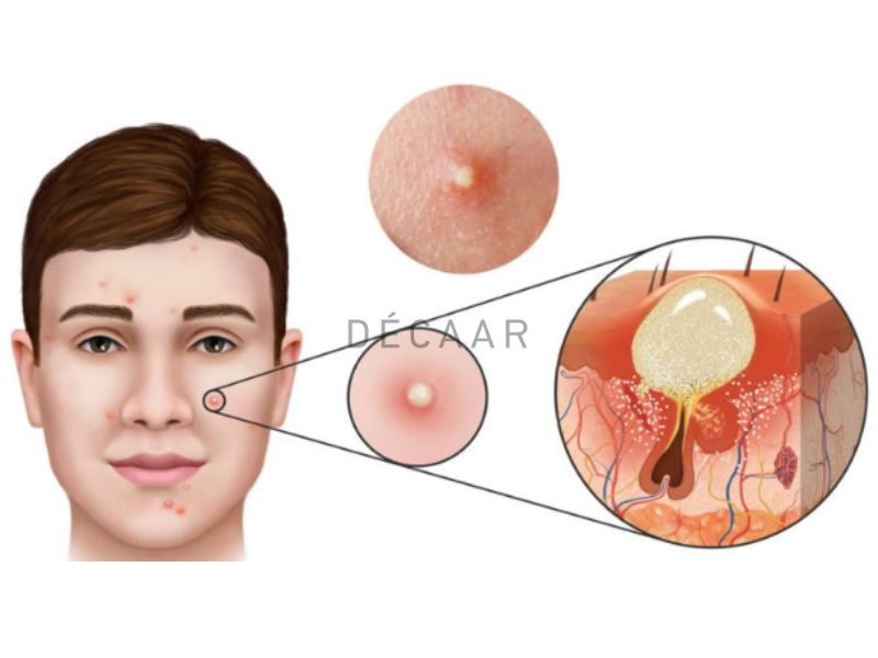 Xác định đúng loại mụn để có phác đồ điều trị hợp lý.